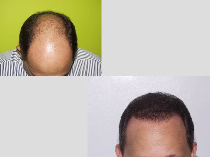 Hair Transplant Institute - Dr. Alba Reyes, MD - Hair Transplant Institute - Dr. Alba Reyes, MD