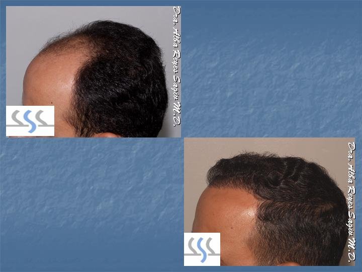 Hair Transplant Institute - Dr. Alba Reyes, MD - Hair Transplant Institute - Dr. Alba Reyes, MD