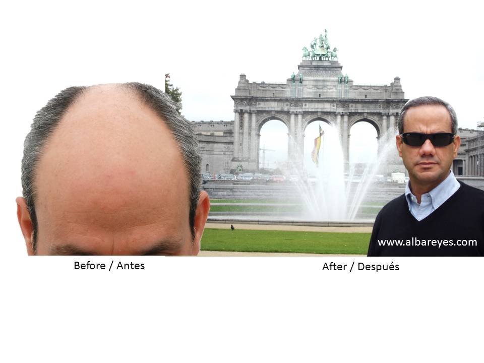 Hair Transplant Institute - Dr. Alba Reyes, MD - Hair Transplant Institute - Dr. Alba Reyes, MD