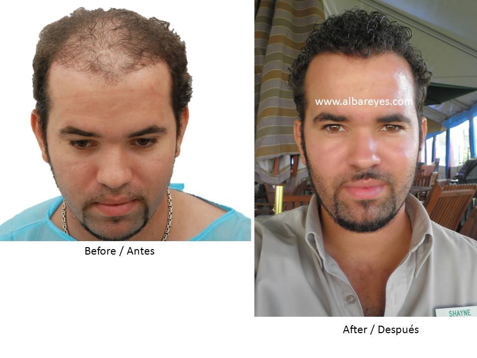 Hair Transplant Institute - Dr. Alba Reyes, MD - Hair Transplant Institute - Dr. Alba Reyes, MD