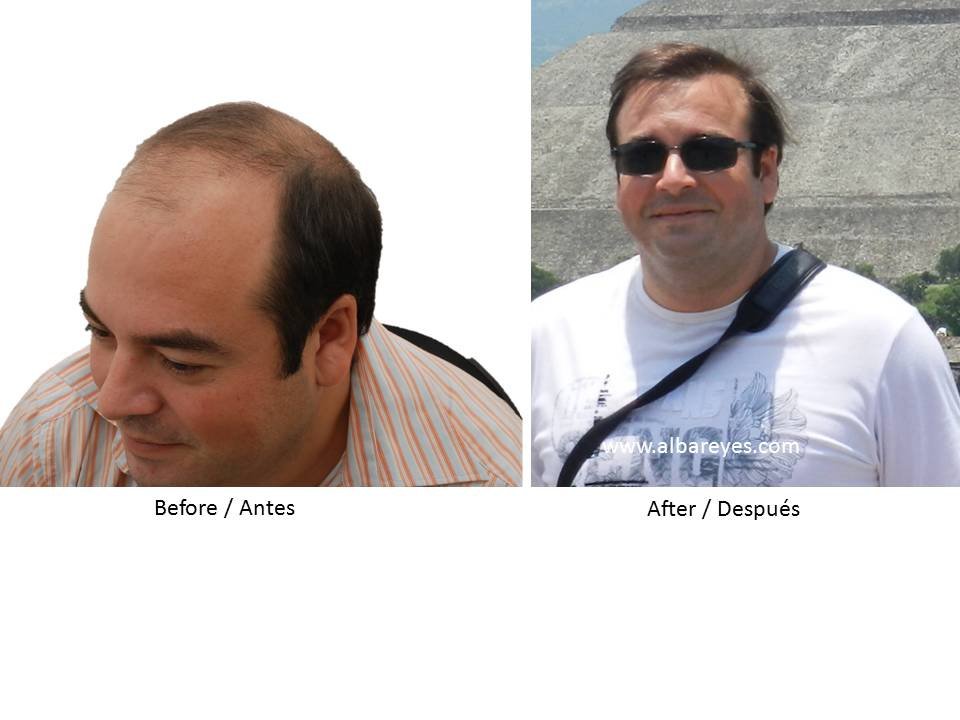 Hair Transplant Institute - Dr. Alba Reyes, MD - Hair Transplant Institute - Dr. Alba Reyes, MD