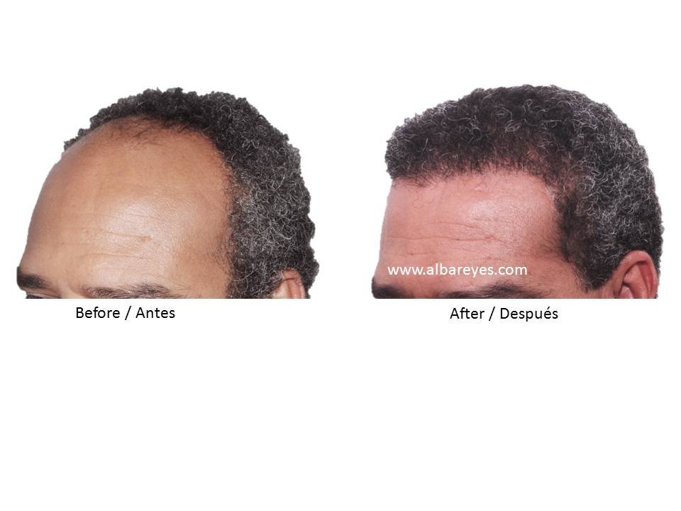 Hair Transplant Institute - Dr. Alba Reyes, MD - Hair Transplant Institute - Dr. Alba Reyes, MD