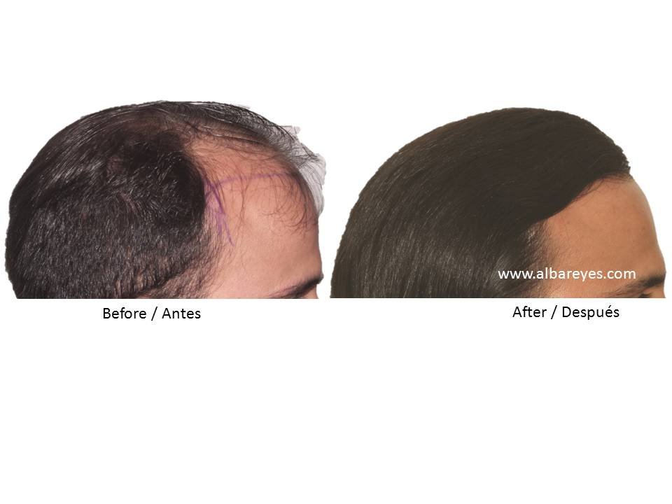 Hair Transplant Institute - Dr. Alba Reyes, MD - Hair Transplant Institute - Dr. Alba Reyes, MD