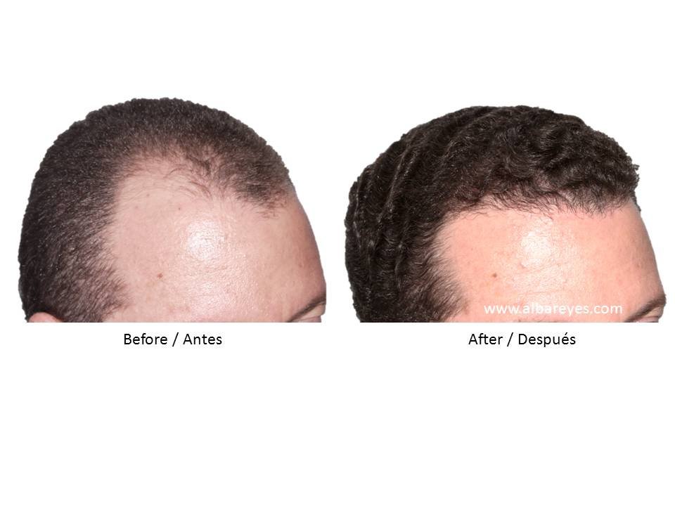 Hair Transplant Institute - Dr. Alba Reyes, MD - Hair Transplant Institute - Dr. Alba Reyes, MD