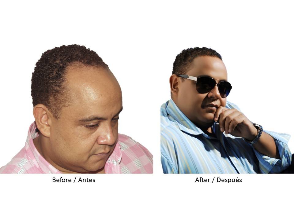 Hair Transplant Institute - Dr. Alba Reyes, MD - Hair Transplant Institute - Dr. Alba Reyes, MD