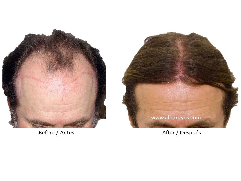 Hair Transplant Institute - Dr. Alba Reyes, MD - Hair Transplant Institute - Dr. Alba Reyes, MD
