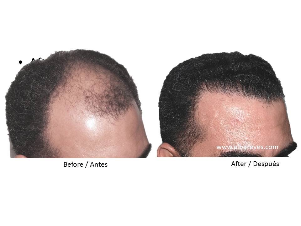 Hair Transplant Institute - Dr. Alba Reyes, MD - Hair Transplant Institute - Dr. Alba Reyes, MD