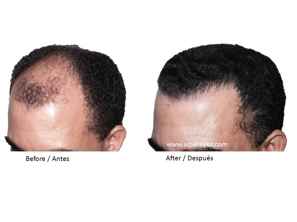 Hair Transplant Institute - Dr. Alba Reyes, MD - Hair Transplant Institute - Dr. Alba Reyes, MD
