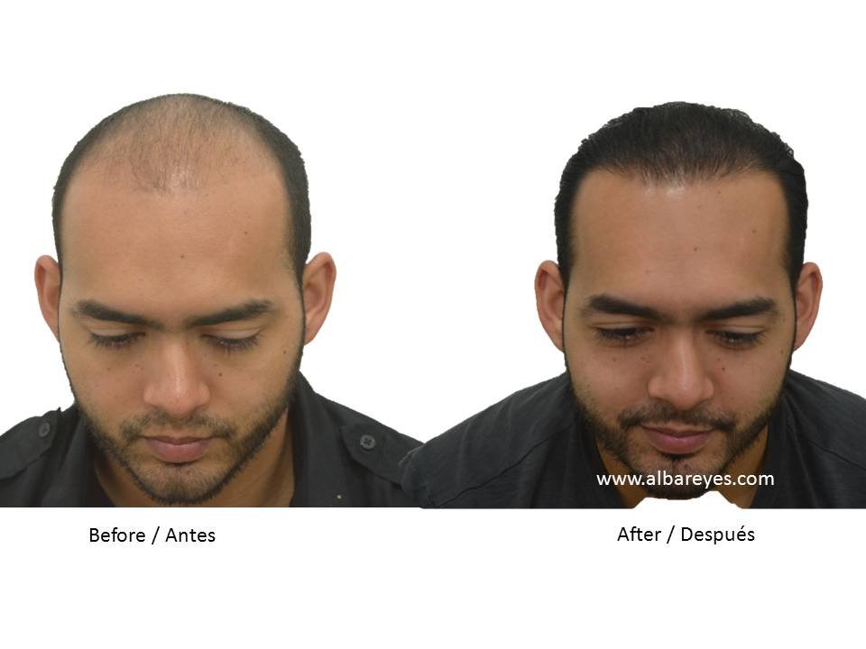 Hair Transplant Institute - Dr. Alba Reyes, MD - Hair Transplant Institute - Dr. Alba Reyes, MD