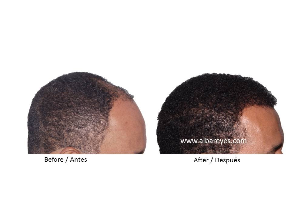 Hair Transplant Institute - Dr. Alba Reyes, MD - Hair Transplant Institute - Dr. Alba Reyes, MD