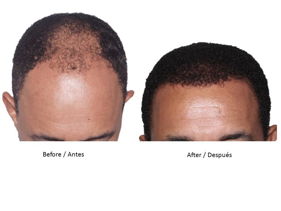 Hair Transplant Institute - Dr. Alba Reyes, MD - Hair Transplant Institute - Dr. Alba Reyes, MD