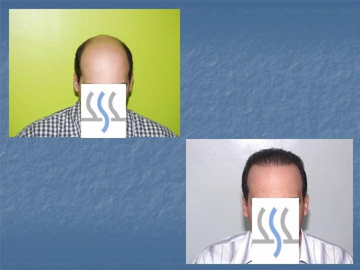 Hair Transplant Institute - Dr. Alba Reyes, MD - Hair Transplant Institute - Dr. Alba Reyes, MD