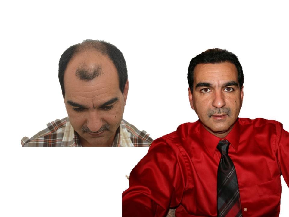 Hair Transplant Institute - Dr. Alba Reyes, MD - Hair Transplant Institute - Dr. Alba Reyes, MD