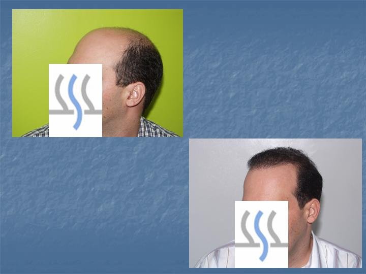 Hair Transplant Institute - Dr. Alba Reyes, MD - Hair Transplant Institute - Dr. Alba Reyes, MD