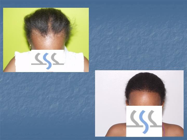 Hair Transplant Institute - Dr. Alba Reyes, MD - Hair Transplant Institute - Dr. Alba Reyes, MD