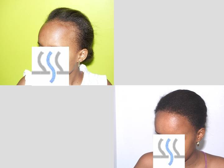 Hair Transplant Institute - Dr. Alba Reyes, MD - Hair Transplant Institute - Dr. Alba Reyes, MD