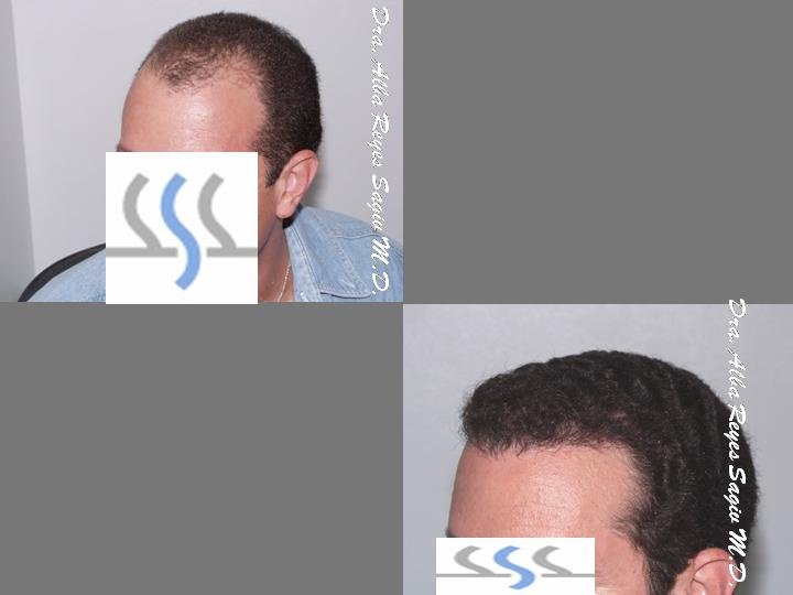 Hair Transplant Institute - Dr. Alba Reyes, MD - Hair Transplant Institute - Dr. Alba Reyes, MD