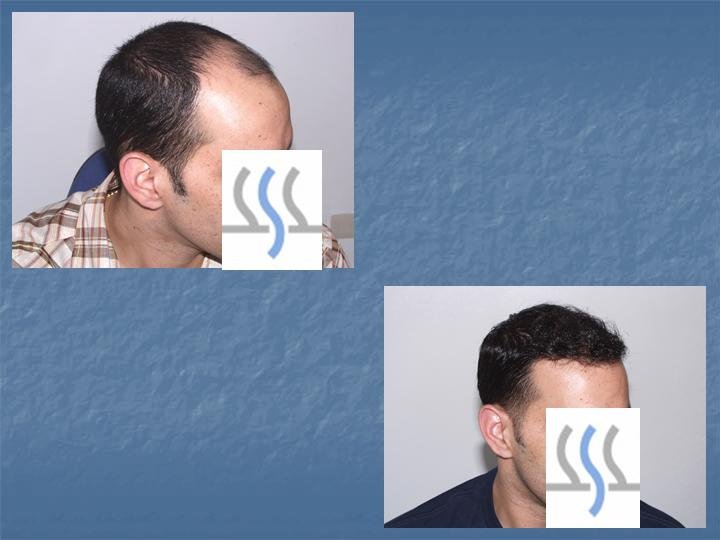 Hair Transplant Institute - Dr. Alba Reyes, MD - Hair Transplant Institute - Dr. Alba Reyes, MD