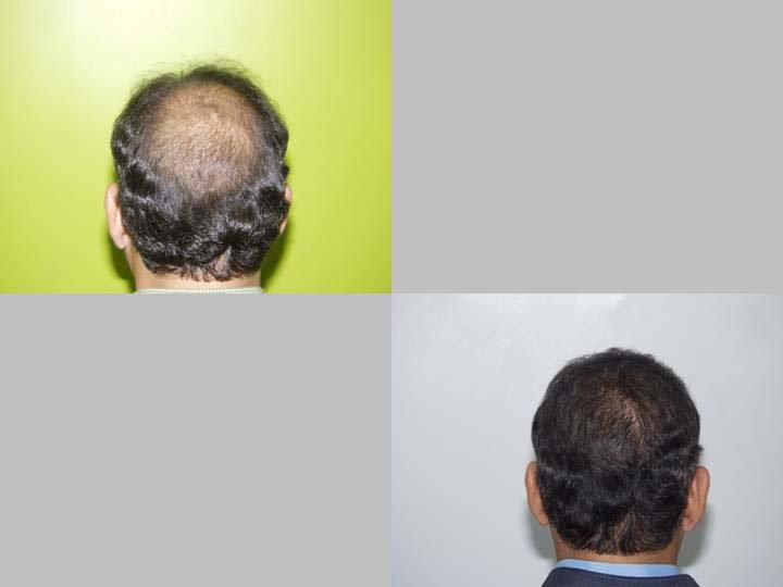 Hair Transplant Institute - Dr. Alba Reyes, MD - Hair Transplant Institute - Dr. Alba Reyes, MD