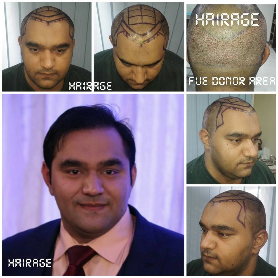 HairAge - Art in Hair Restoration - HairAge - Art in Hair Restoration
