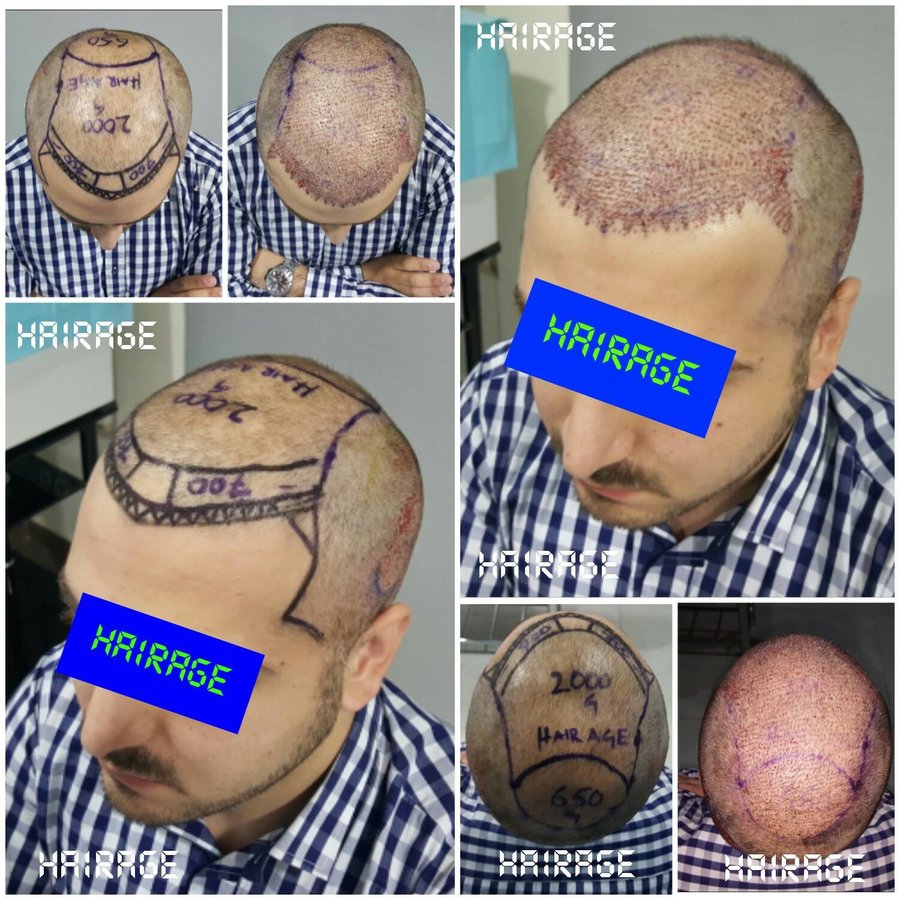 HairAge - Art in Hair Restoration - HairAge - Art in Hair Restoration