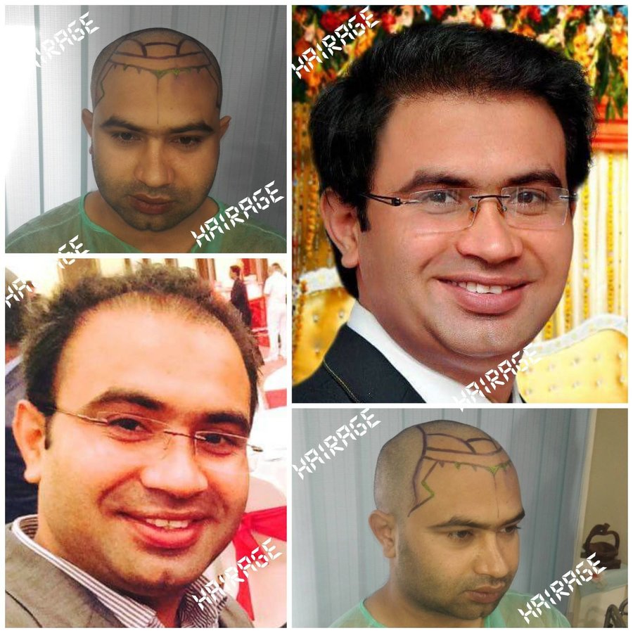 HairAge - Art in Hair Restoration - HairAge - Art in Hair Restoration