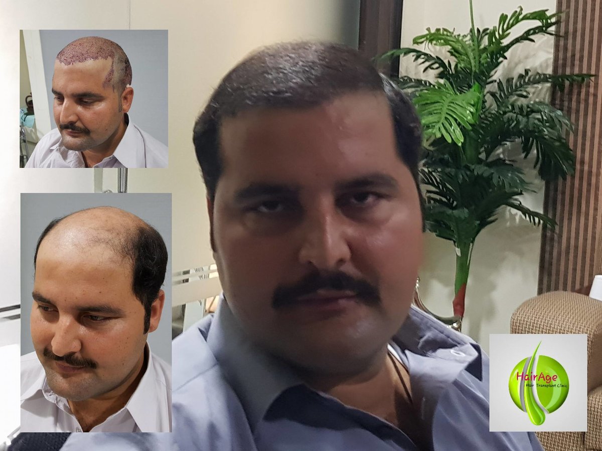 HairAge - Art in Hair Restoration - HairAge - Art in Hair Restoration