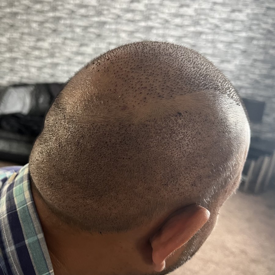 Hairestetik Turkey Hair Transplant Center - Hairestetik Turkey Hair Transplant Center