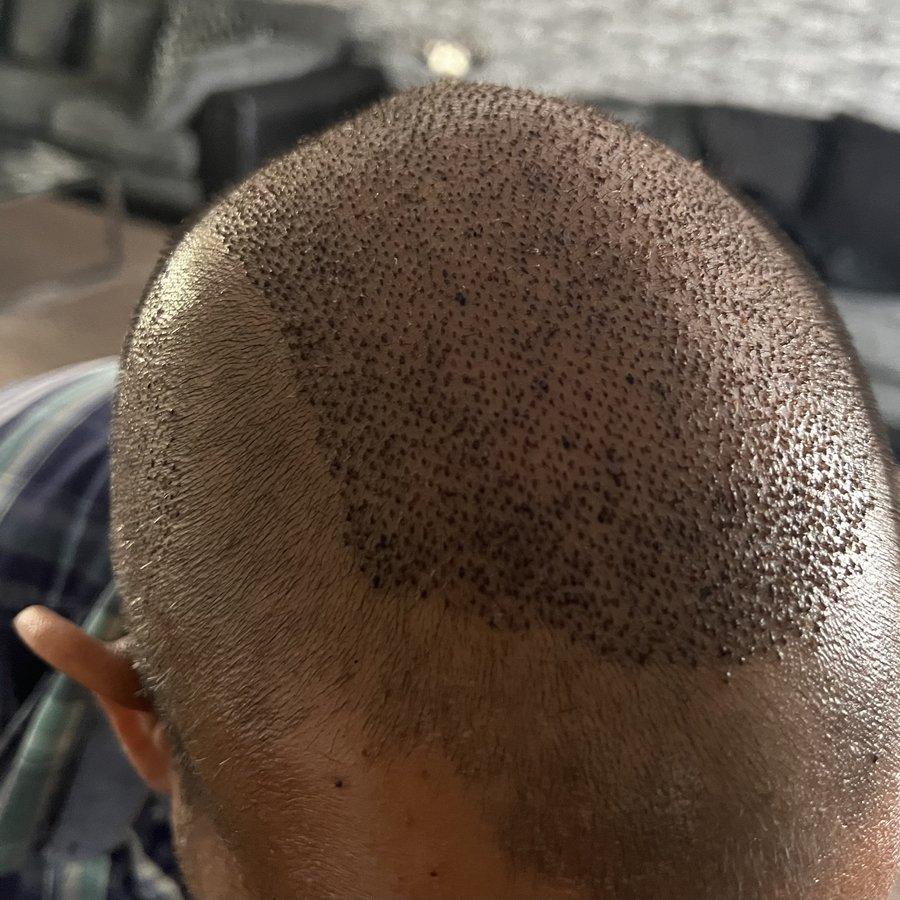 Hairestetik Turkey Hair Transplant Center - Hairestetik Turkey Hair Transplant Center