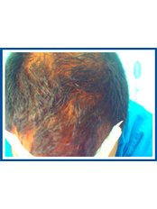شعري - Hairline