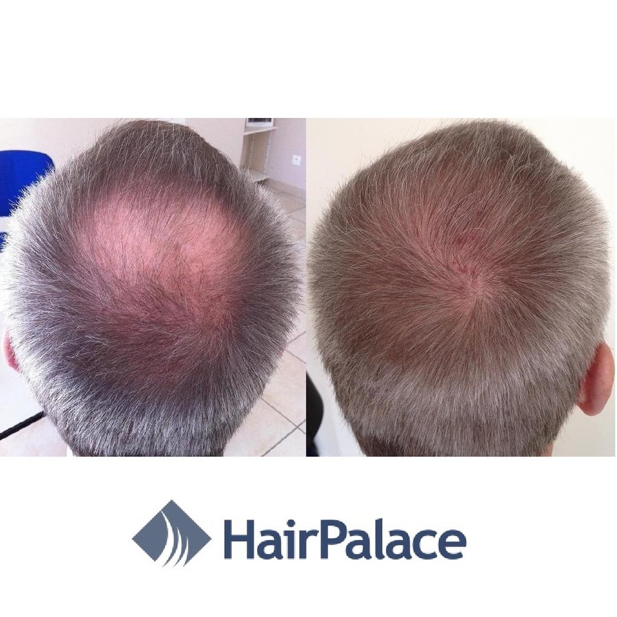 HairPalace Clinique de Greffe de Cheveux France - HairPalace Clinique de Greffe de Cheveux France