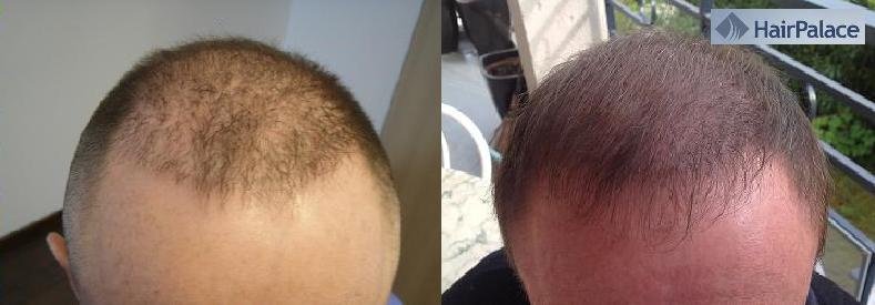 HairPalace Clinique de Greffe de Cheveux France - HairPalace Clinique de Greffe de Cheveux France