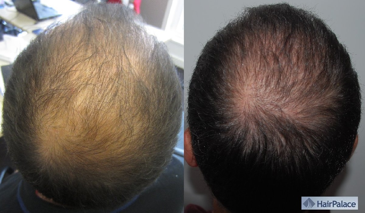 HairPalace Clinique de Greffe de Cheveux France - HairPalace Clinique de Greffe de Cheveux France