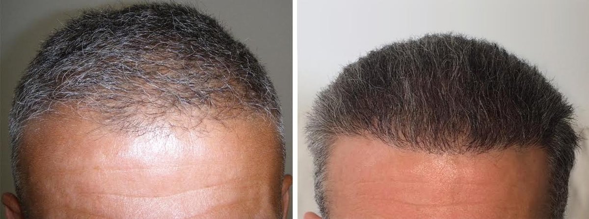 HairPalace Clinique de Greffe de Cheveux France - HairPalace Clinique de Greffe de Cheveux France