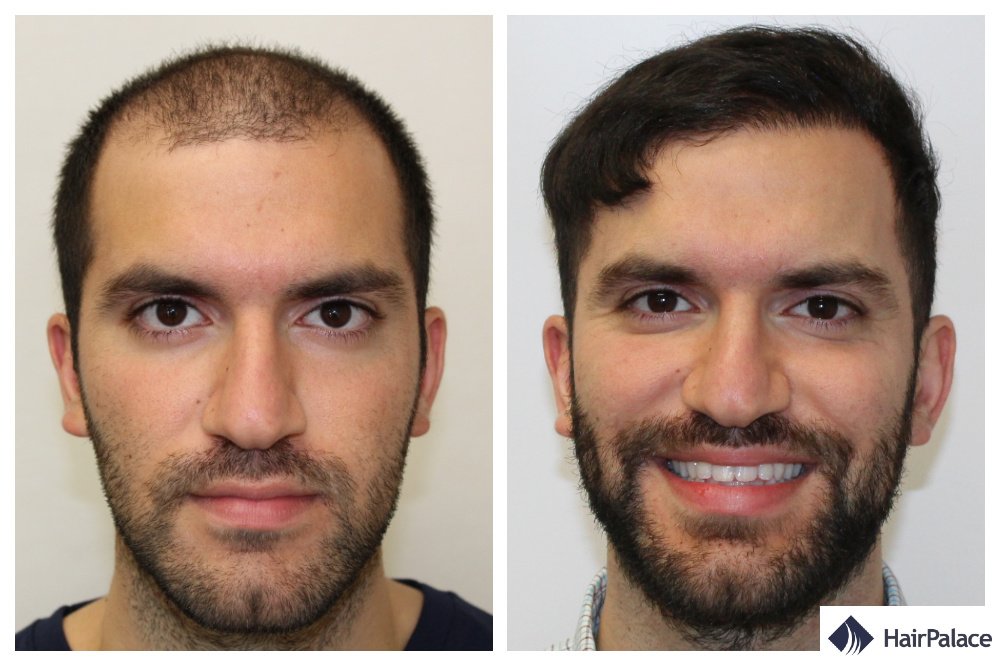 HairPalace Hair Transplant Clinic - HairPalace Hair Transplant Clinic