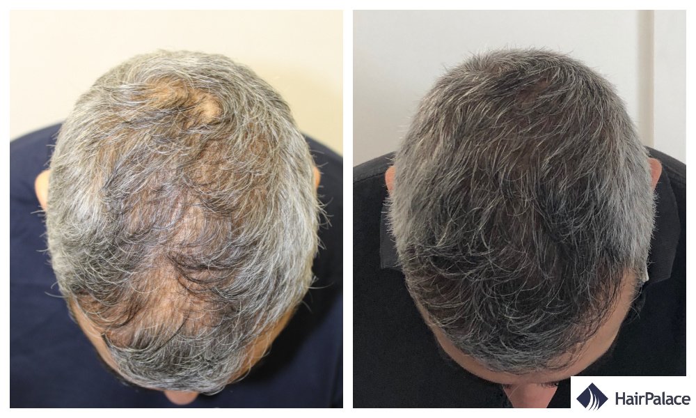 HairPalace Hair Transplant Clinic - HairPalace Hair Transplant Clinic