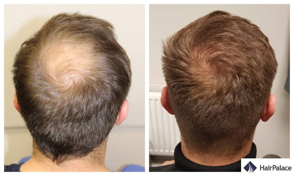 HairPalace Hair Transplant Clinic - HairPalace Hair Transplant Clinic