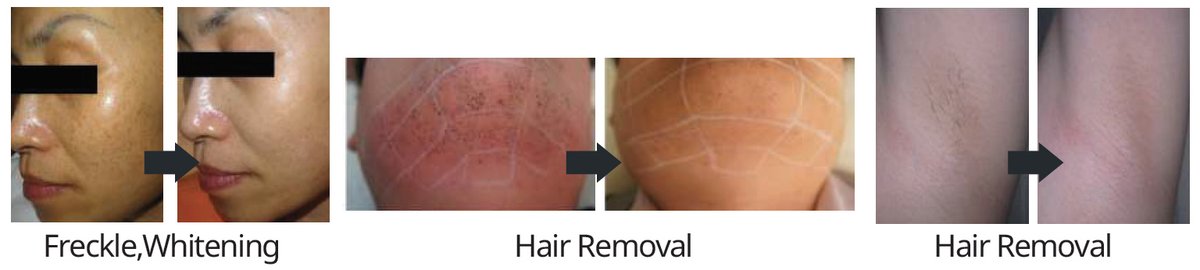 Hands On Laser and Beauty Therapy - Hands On Laser and Beauty Therapy