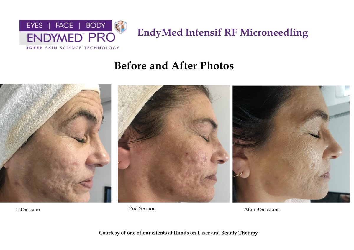 Hands On Laser and Beauty Therapy - Hands On Laser and Beauty Therapy