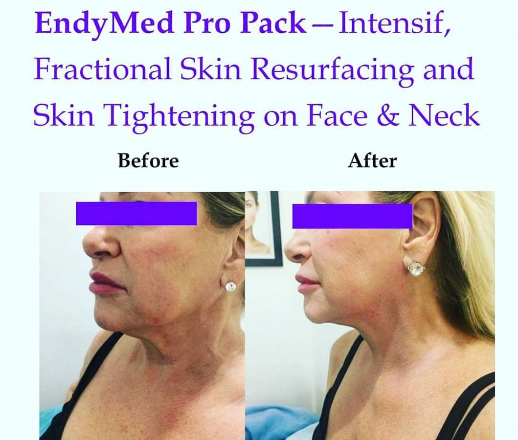 Hands On Laser and Beauty Therapy - Hands On Laser and Beauty Therapy