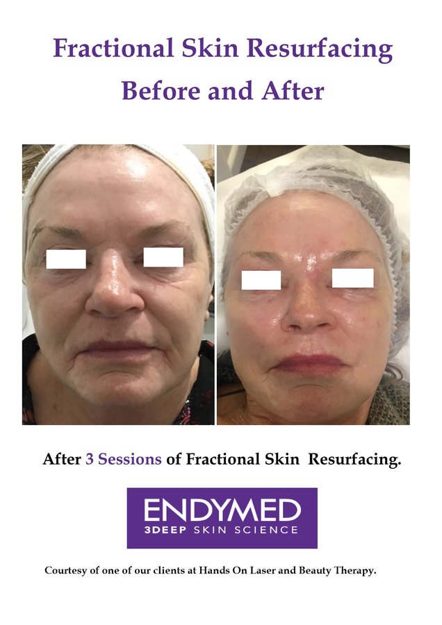 Hands On Laser and Beauty Therapy - Hands On Laser and Beauty Therapy