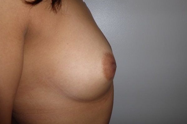 عيادة هارلي للثدي - Harley Breast Clinic