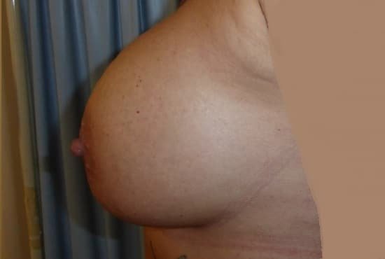 عيادة هارلي للثدي - Harley Breast Clinic