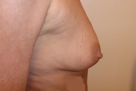 عيادة هارلي للثدي - Harley Breast Clinic