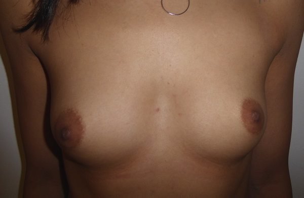 عيادة هارلي للثدي - Harley Breast Clinic