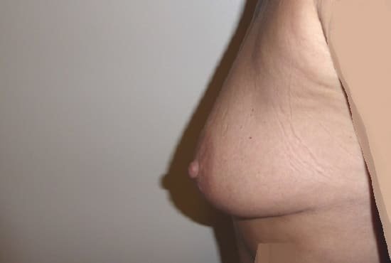 عيادة هارلي للثدي - Harley Breast Clinic