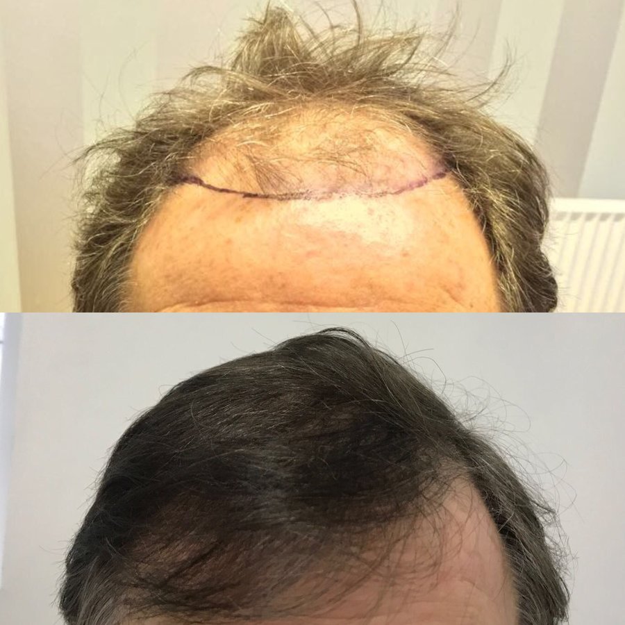 Harris Hair Transplant UK - Harris Hair Transplant UK