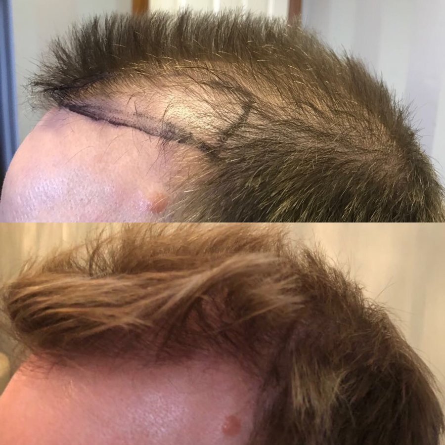 Harris Hair Transplant UK - Harris Hair Transplant UK