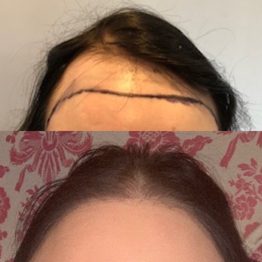 Harris Hair Transplant UK - Harris Hair Transplant UK