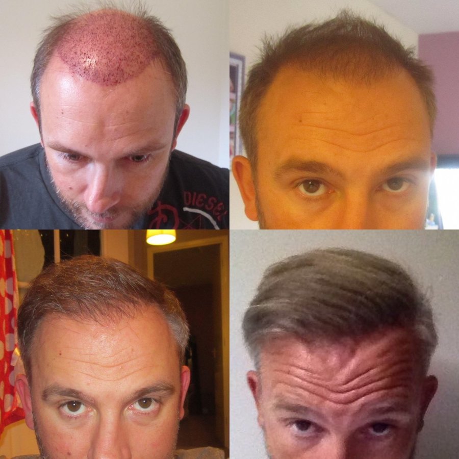 Harris Hair Transplant UK - Harris Hair Transplant UK